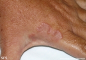 granuloma annulare