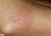 granuloma annulare