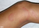 granuloma annulare