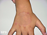 granuloma annulare