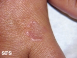 granuloma annulare
