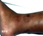 granuloma annulare