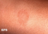 granuloma annulare
