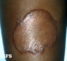 granuloma annulare