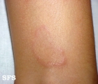 granuloma annulare