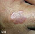 granuloma annulare