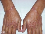 granuloma annulare