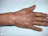granuloma annulare