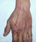 granuloma annulare