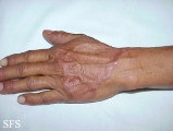 granuloma annulare