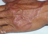 granuloma annulare