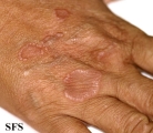 granuloma annulare