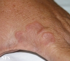 granuloma annulare