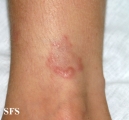 granuloma annulare