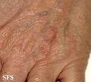 granuloma annulare