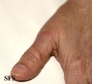 granuloma annulare