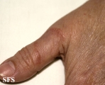 granuloma annulare