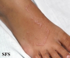 granuloma annulare