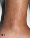 granuloma annulare
