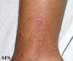 granuloma annulare