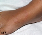 granuloma annulare
