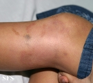 granuloma annulare