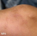 granuloma annulare