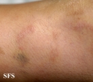 granuloma annulare