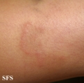 granuloma annulare