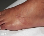 granuloma annulare