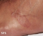 granuloma annulare
