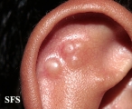 granuloma annulare