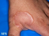 granuloma annulare