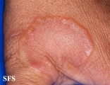 granuloma annulare