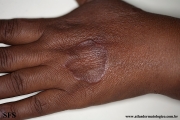 granuloma annulare