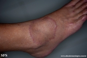 granuloma annulare