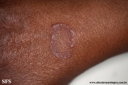 granuloma annulare