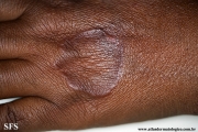 granuloma annulare