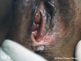 leukoplakia-vulvar leukoplakia