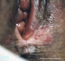 leukoplakia-vulvar leukoplakia