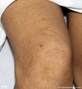 xanthoma eruptive