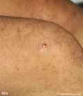 xanthoma eruptive