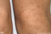 xanthoma eruptive