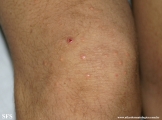 xanthoma eruptive