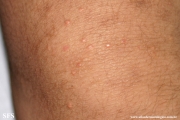 xanthoma eruptive
