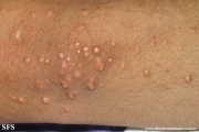 xanthoma eruptive