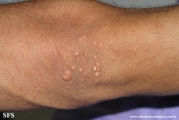 xanthoma eruptive
