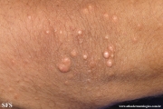 xanthoma eruptive
