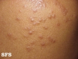 scabies atypical