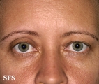 blepharochalasis-unilateral blepharochalasis